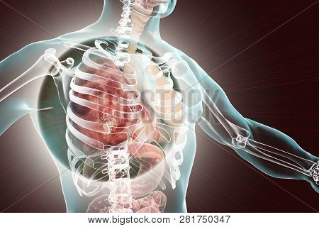 Pneumonia Medical Concept, 3d Illustration Showing Lobar Pneumonia Of The Right Lung In The Phase Of