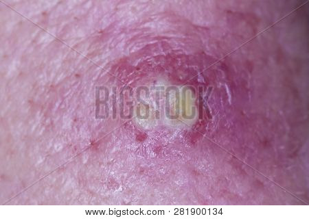 Purulent Red Pimple On Human Face Skin