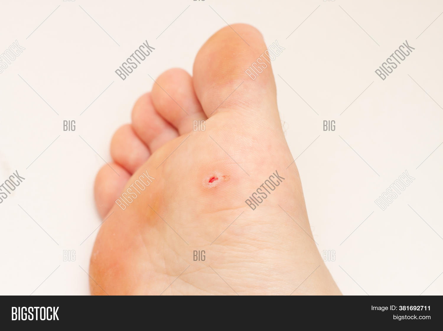 Plantar Wart On Foot. Image & Photo (Free Trial) Bigstock