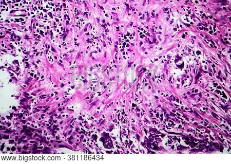 Breast Ductal Carcinoma, Light Micrograph, Photo Under Microscope