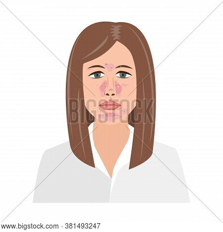 Unhappy Woman Suffering From Seborrheic Dermatitis. Vector Illustration. Adult Or Teenager Face With