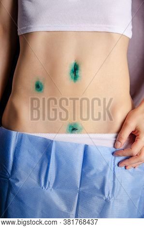 Middle Age Caucasian Female Shows Her Healing  Scars After Laparoscopic Appendix Removal Surgery