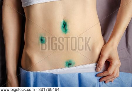 Middle Age Caucasian Female Shows Her Healing  Scars After Laparoscopic Appendix Removal Surgery