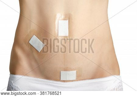 Caucasian Model Demonstrates Abdomen After Laparoscopic Appendix Removal Surgery. White Background