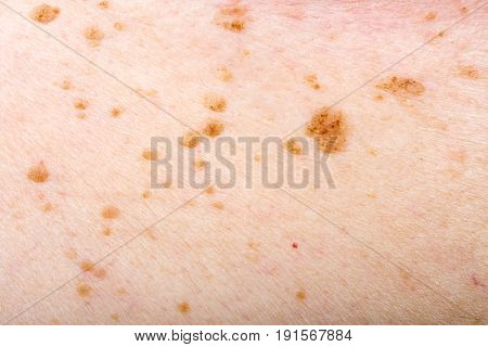 Close up photo of many nevus on human skin