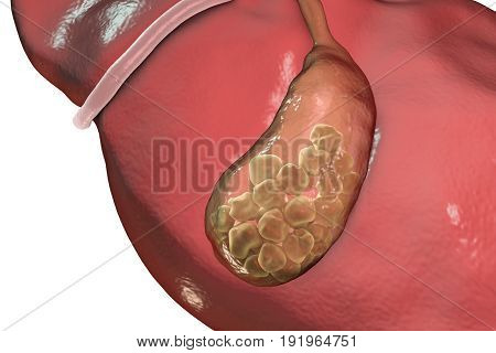 Gallstones, 3D illustration showing bottom view of liver and gallbladder with stones