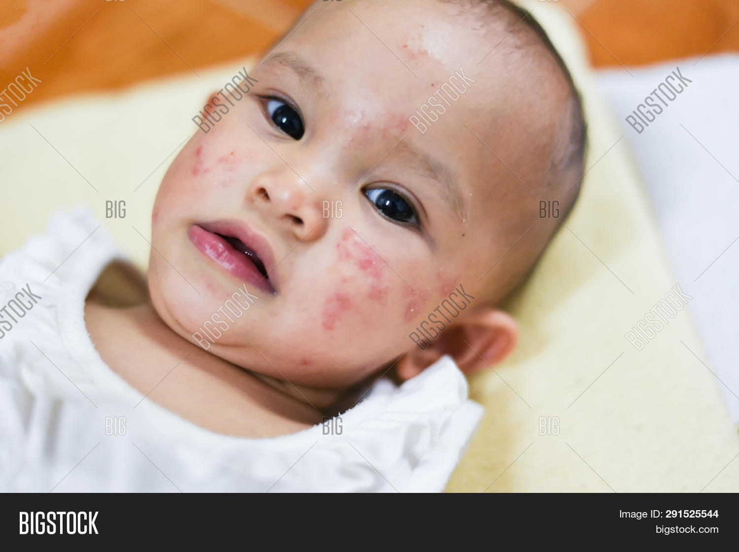 Rash Baby Allergy On Image & Photo (Free Trial) Bigstock