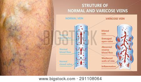 Varicose Veins On A Female Senior Legs. The Structure Of Normal And Varicose Veins. Concept Of Dry S
