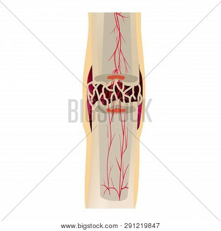 3 Stage Of Healing Bone Fracture. Callus Ossification. The Bone Fracture. Infographics. Vector Illus