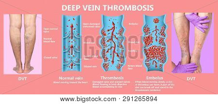 Deep Vein Thrombosis Or Blood Clots. Embolus. Structure Of Normal And Varicose Female Veins
