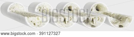 Osteoporosis 4 Stages -12k Very Detailed - 3d Rendering
