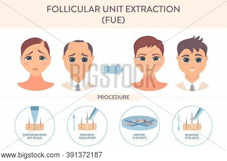 Fue Hair Transplantation Procedure Medical Infographic Poster