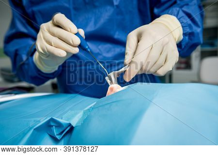Functional Rhinosurgery To Restore Nasal Breathing With Coblation Technology.