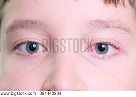 A Boy With Red Irritated Eye After Long Time Using Gadgets, Tired Eyes Concept