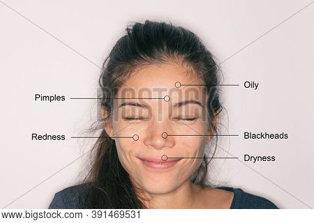 Facial skincare Asian woman with skin problems. Funny portrait of girl smiling with oily forehead, dry lips, redness or dryness, mixed skin T-zone clogged pores blackheads. Beauty therapy.