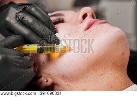 Close-up Snapshot Of Plasmolifting Procedure Injection. Doctor Cosmetologist Beautician In Sterile G