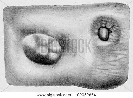 Part of cutaneous surface of right mamma, vintage engraved illustration. 