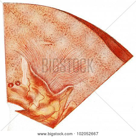 Kidney, chronic parenchymatous nephritis, vintage engraved illustration. 