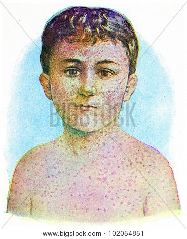 Measles, vintage engraved illustration. 