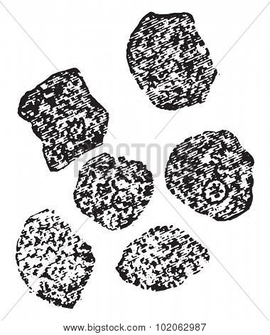 Granular degeneration(cloudy swelling) of liver cells, vintage engraved illustration. 