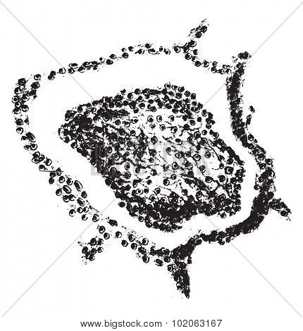 Croupous pneumonia, vintage engraved illustration. 