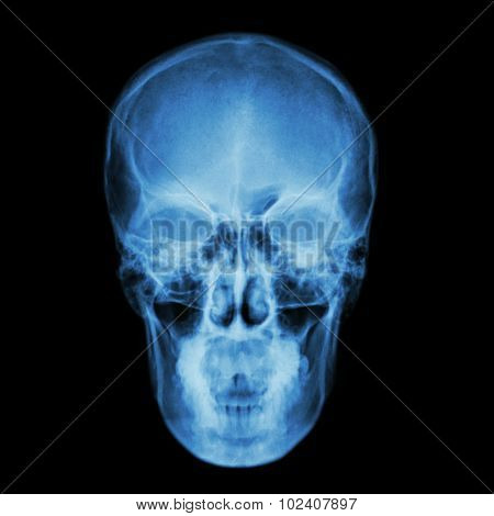 X-ray Skull And Stroke ( Cerebrovascular Accident (cva) )