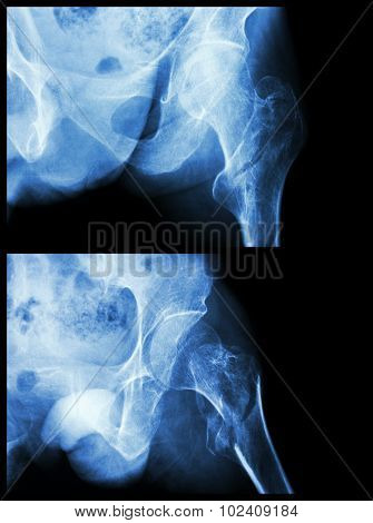 Fracture Head Of Femur(thigh Bone) (intertrochanteric Fracture)  (2 Position)