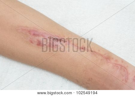 Old scar wound in the forearm