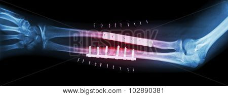 Fracture Both Bone Of Forearm