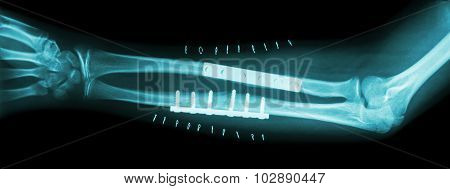 Fracture both bone of forearm ( ulnar and radius ) . It was operated and internal fixed by plate and screw