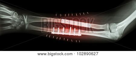 Fracture Both Bone Of Forearm ( Ulnar And Radius )