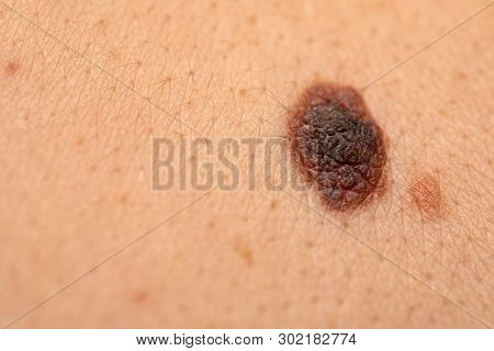 Close Up Picture Of Dangerous Brown Nevus On Human Skin - Melanoma