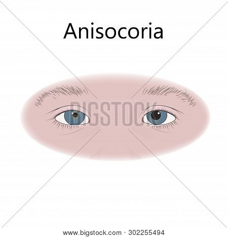 Anisocoria In Infants, Child, Kid, Pupils Of Different Sizes. Vector Flat Medical Illustration.