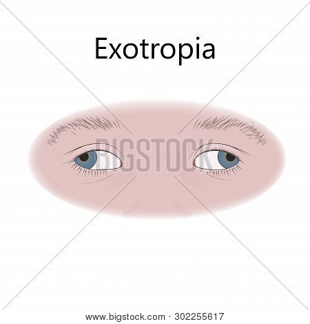 Strabismus In Infants, Child, Kid. Exotropia, Wall-eyed, Outward Eyes. Vector Flat Medical Illustrat