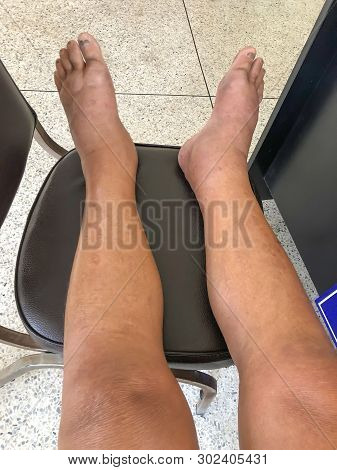 Blurred Picture Of The Feet Of Patients With Edema. The Presence Of Water Or Lymph Accumulates Leewa