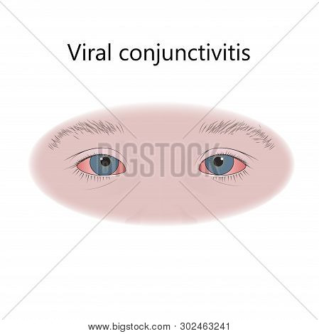 Viral Conjunctivitis In Infants, Kids, Child. Virus. Vector Flat Medical Illustration.