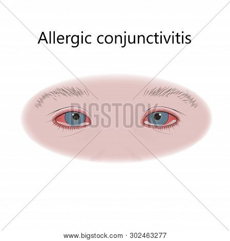 Allergic Conjunctivitis. Allergy. Vector Flat Medical Illustration.