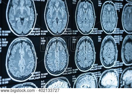 Mri, Computed Tomography Of The Spine. Checking Back Sections In The Hospital.