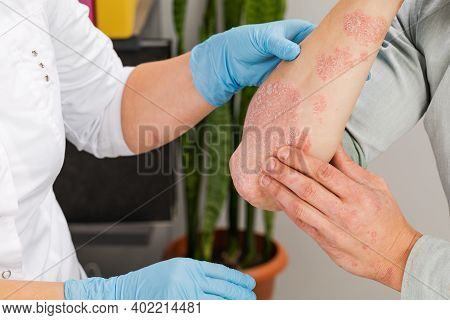 A Dermatologist Wearing Gloves Examines The Skin Of A Sick Patient. Examination And Diagnosis Of Ski