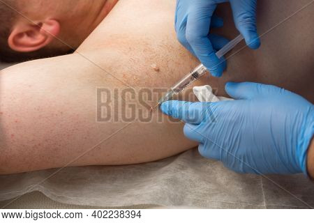 Surgeon In Gloves Gives Injection Of Local Anesthesia To Patient Before Laser Removing Of Moles Or P