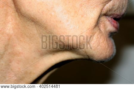 Nasolabial Wrinkles. Wrinkles On The Skin Of The Face Of The Neck. Flabby Cheeks And Neck