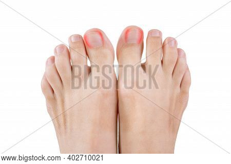 Ingrown Toenails On A Woman's Foot, Isolated On White Background, Pain In The Big Toe