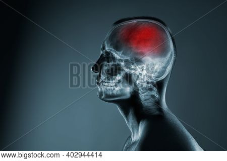 X-ray Of A Mans Head. Cerebral Stroke. Brain Damage Is Highlighted By Red Colour.