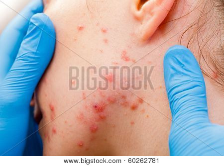 Acne Skin