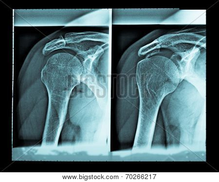Xray