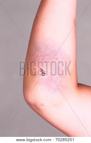 large hematoma on human arm