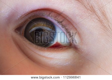 Red Bloddshot Eyes