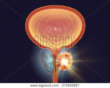 Conceptual image for prostate cancer treatment, 3D illustration showing destruction of a tumor inside prostate gland