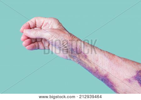 Photo of injured elderly woman hands on blue backround