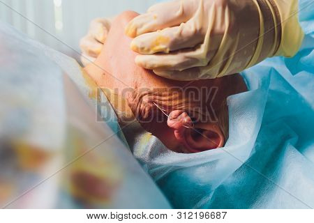 Aged Woman Doing Mesothreads And Thread Lifting, Cosmetology. Cosmetic Procedure To Eliminate Signs 
